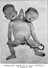 Soeurs siamoises